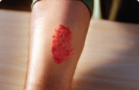 https://cms.candidpowder.comInfection Image